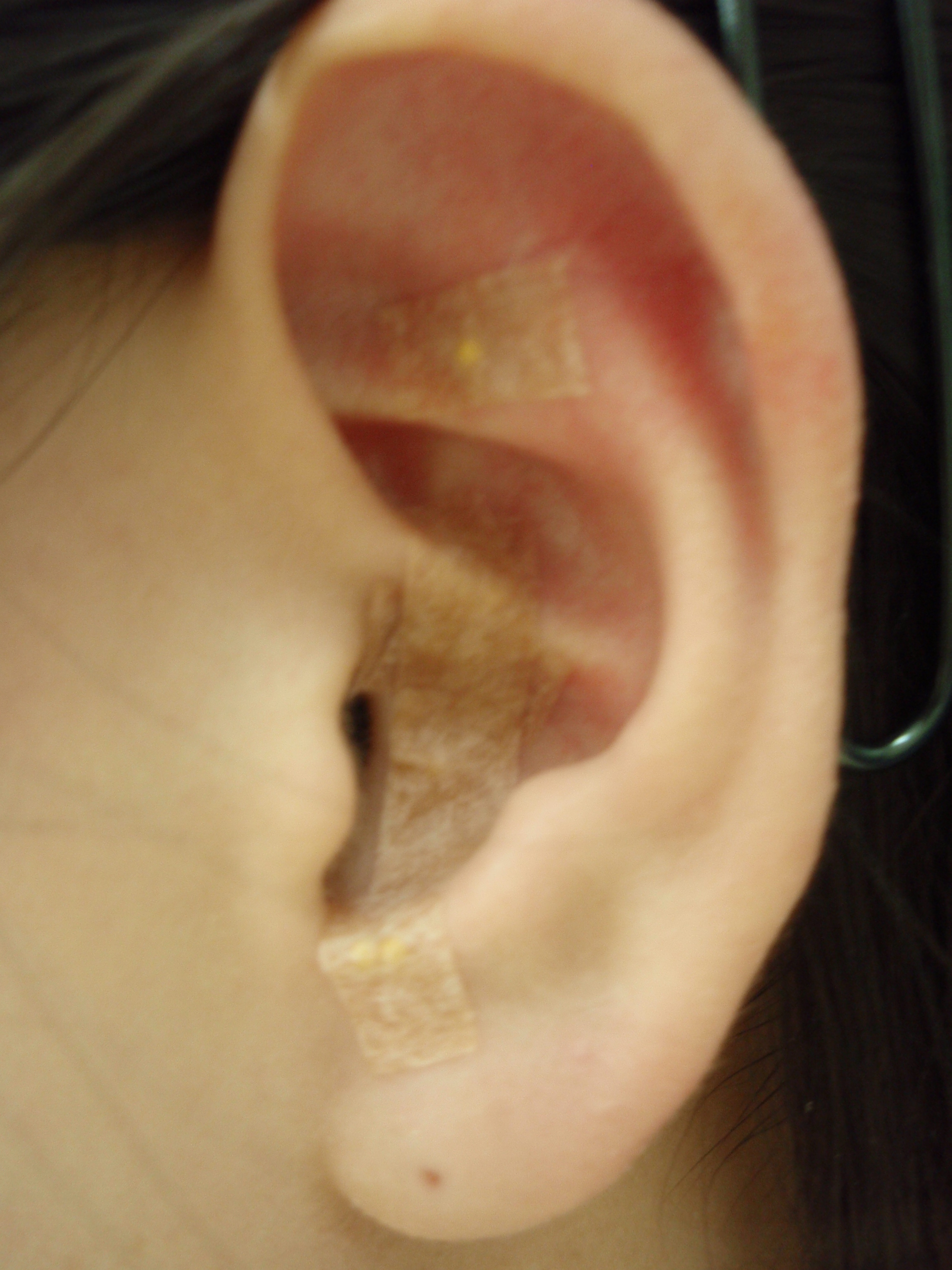 耳ツボダイエット施術をした耳の写真